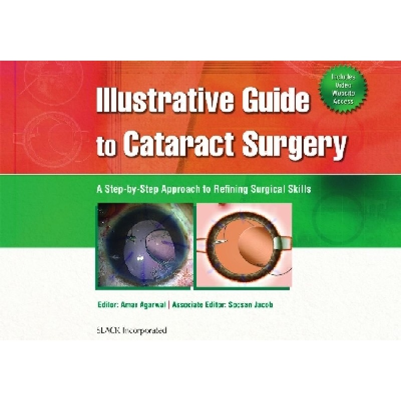 Illustrative Guide to Cataract Surgery